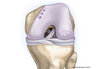 Back in the Game: Cartilage Surgery Shows Strong Promise for Athletes