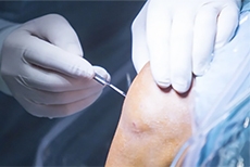 Can Athletes Return to Sports After Knee Cartilage Surgery? What the Latest Research Shows