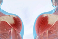 How Long Does a Bankart Repair Last? What a 23-Year Study Reveals About Shoulder Stabiliza...
