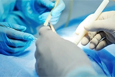 Long-Term Outcomes After Hip Arthroscopy in Patients With Acetabular Retroversion