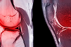 Meniscal Ramp Lesions With ACL Tears: Why MRI and Surgery May Show Different Findings