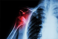 One and Done? How Early Surgery May Prevent Future Shoulder Dislocations