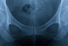 Periacetabular Osteotomy Improves Outcomes in Borderline Hip Dysplasia