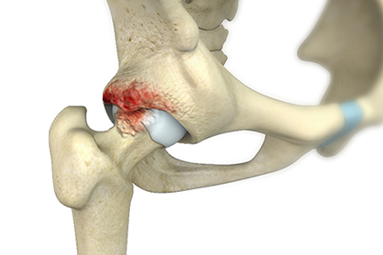 Revolutionizing Adolescent Hip Impingement Treatment in Minneapolis Minnesota: A Leap Forward with Arthroscopy