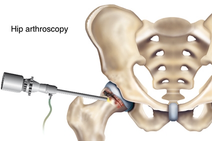 Second Time's Tougher: How First-Time Hip Surgery Outshines Revisions