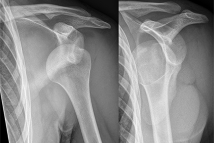 Stronger Shoulders for the Long Haul: What Works Best for Teen Athletes?