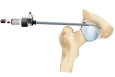 Why First-Time Hip Surgery Offers the Best Chance for Recovery