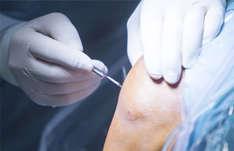 Can Athletes Return to Sports After Knee Cartilage Surgery? What the Latest Research Shows