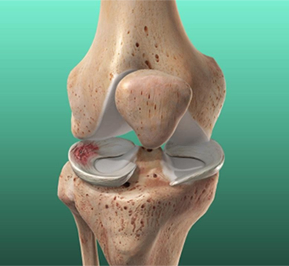 Don’t Wait to Fix It: Early Meniscus Repair Leads to Better Results