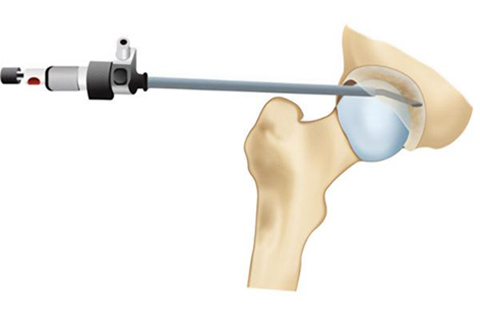 Why Fixing a Torn Knee Root May Be the Best Choice for Long-Term Relief