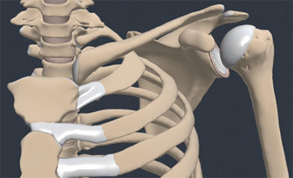 One and Done? How Early Surgery May Prevent Future Shoulder Dislocations