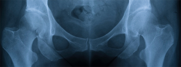 Periacetabular Osteotomy Improves Outcomes in Borderline Hip Dysplasia