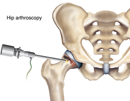 Second Time's Tougher: How First-Time Hip Surgery Outshines Revisions