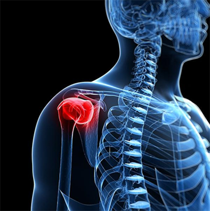 Shoulder Instability: Is Open Latarjet the Superior Long-Term Solution?