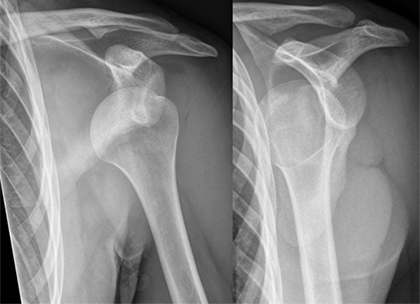 Stronger Shoulders for the Long Haul: What Works Best for Teen Athletes?