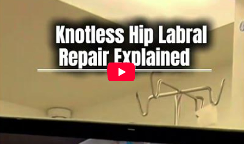 knotless-labral-repair